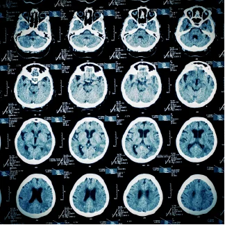 How Traumatic Brain Injury Affects Children and Adolescents