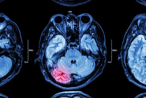 Identifying Victims of Traumatic Brain Injuries