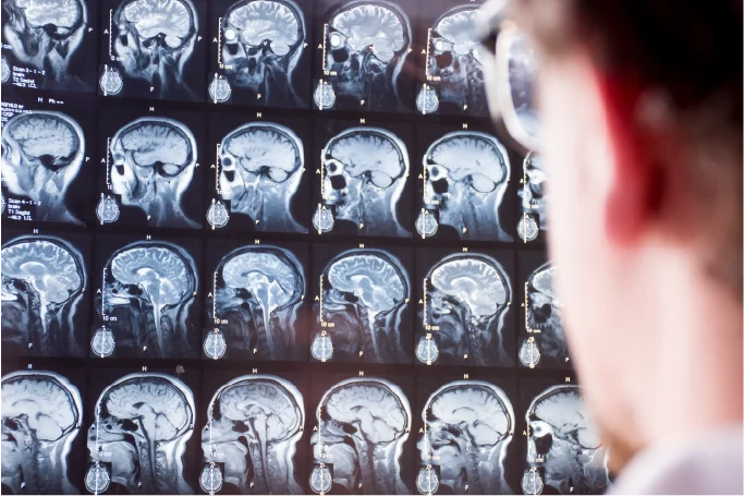 How Concussions Affect Women Differently than Men