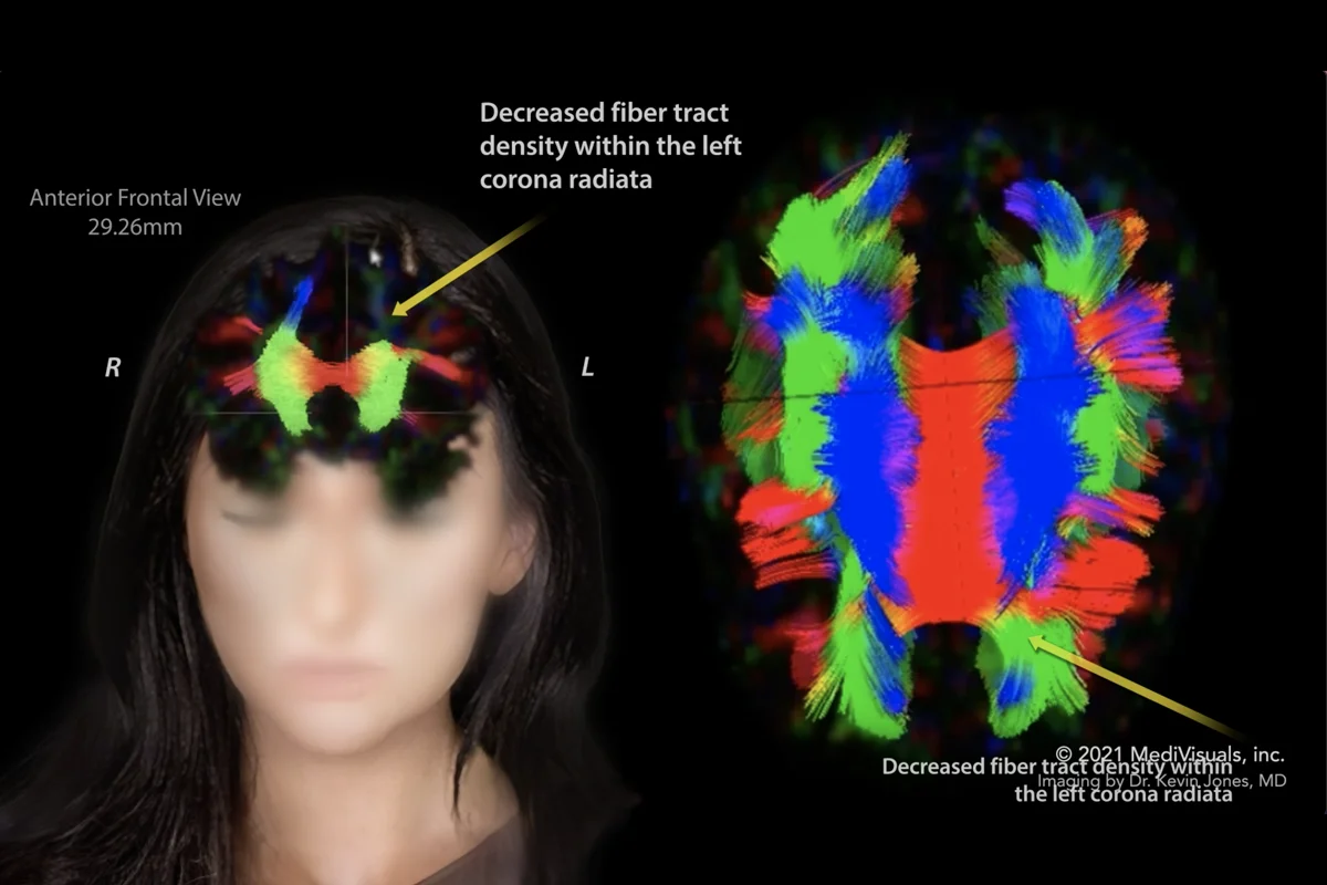 $2.2 Million Settlement – Traumatic Brain Injury